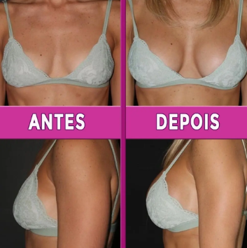 Comparação antes e depois do uso do Beauty Seios